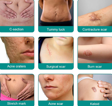 Advanced Scar Removal Spray