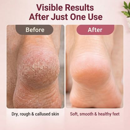 Electric Foot Callus Remover – Dead Skin Scrubber & Pedicure File